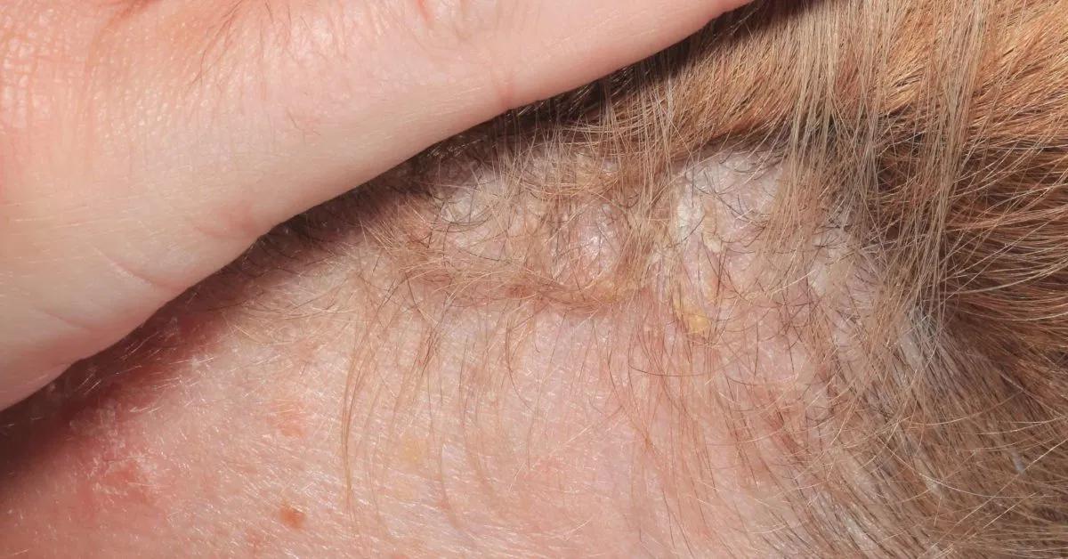 se puede teñir el pelo con psoriasis - Cómo afecta la psoriasis al pelo