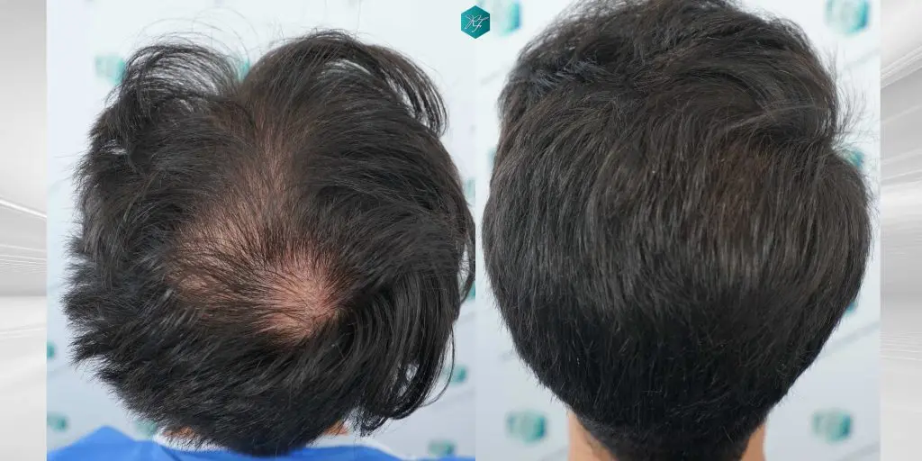 como aumentar el pelo en la coronilla - Cómo aumentar la densidad del cabello en la zona de la coronilla