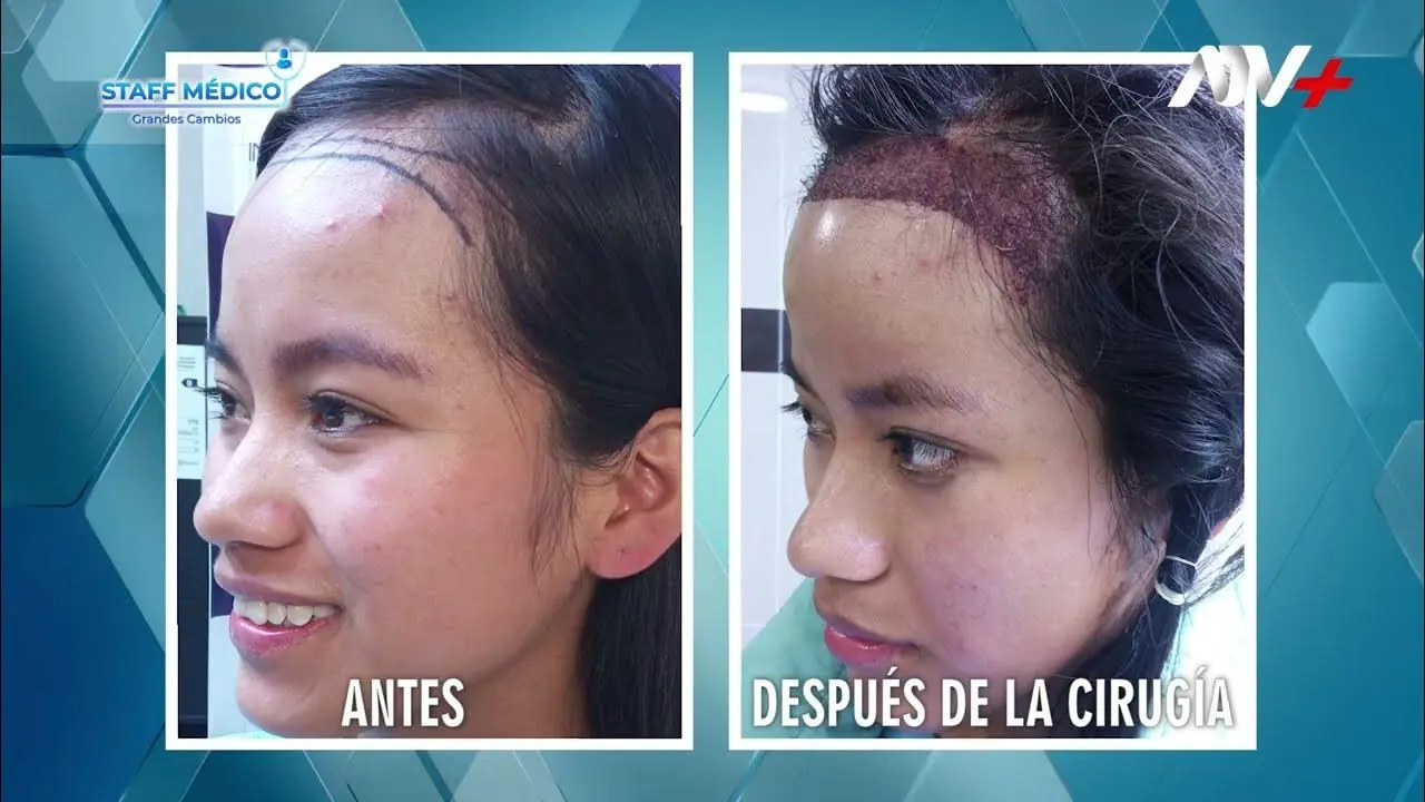 injerto de pelo en mujeres - Cómo es el injerto de cabello en mujeres