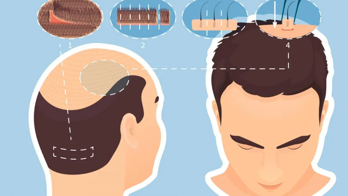 como se hace un injerto de pelo - Cómo es el proceso de injerto de cabello