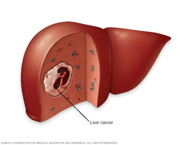 decoloracion capilar cancer higado - Cómo es la etapa final del cáncer de hígado