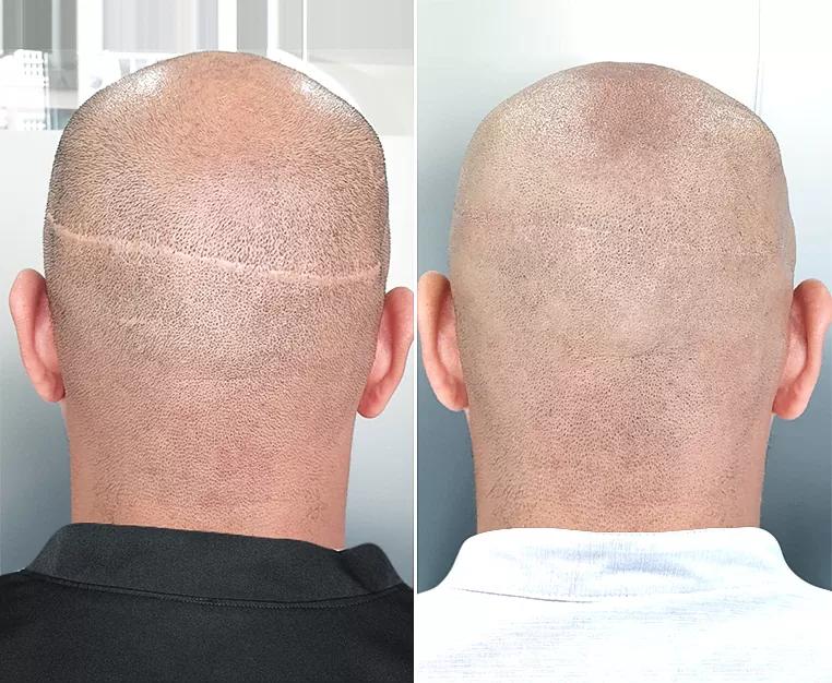 como simular una cicatris de un trasplante capilar - Cómo ocultar una cicatriz de trasplante de cabello