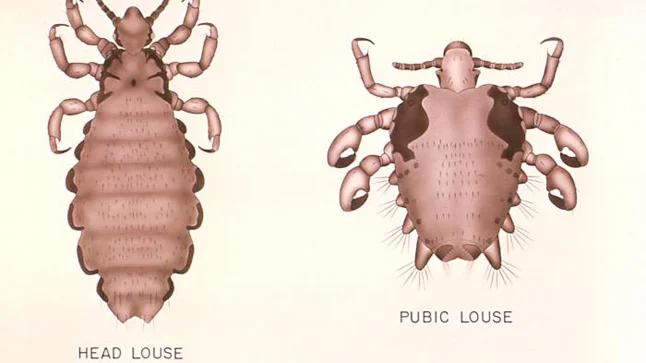 como saber si tengo piojos en el pelo - Cómo saber si tienes piojos sin peine