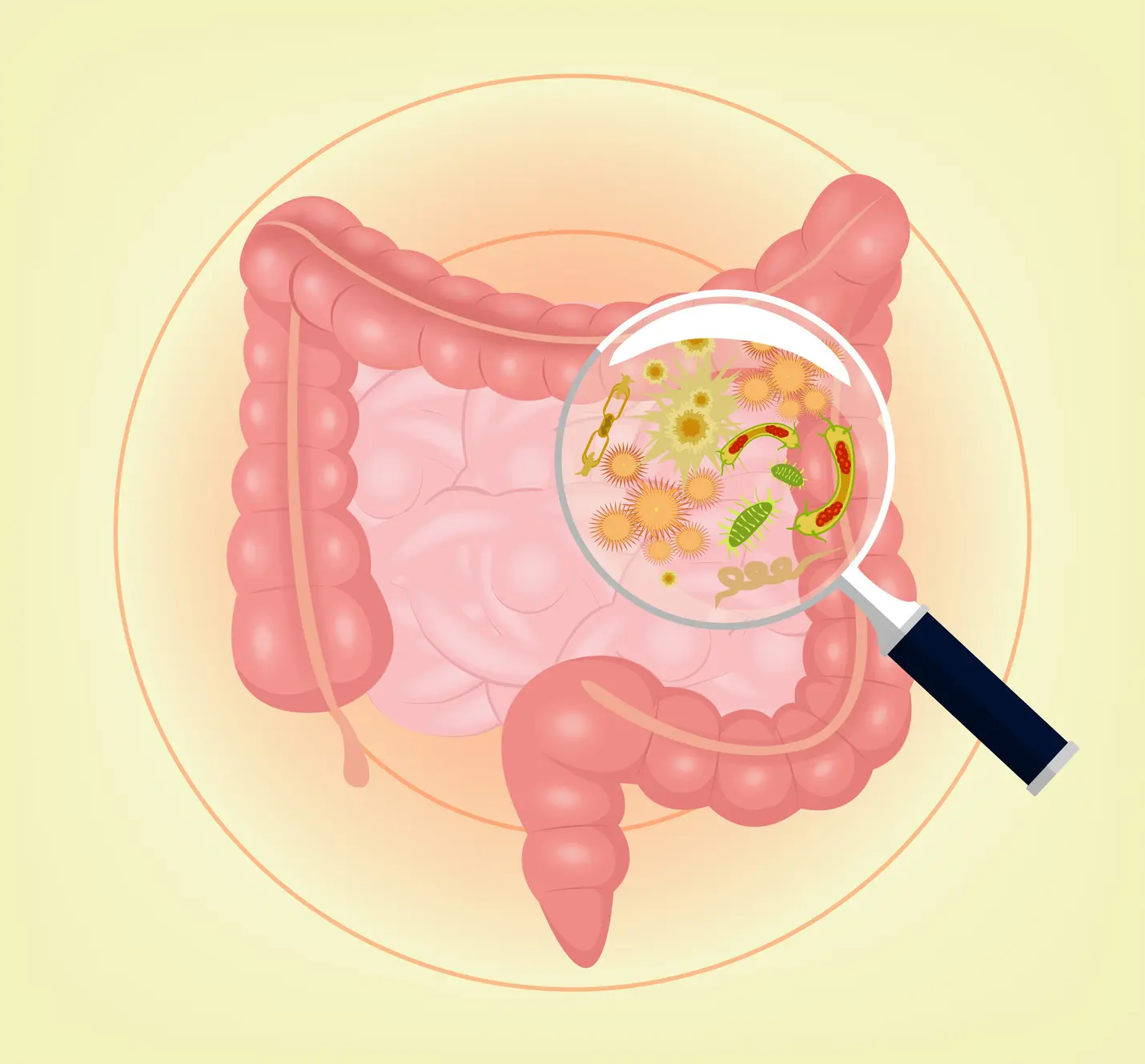 inflamacion de capilar intestinal - Cómo saber si tienes una enfermedad inflamatoria intestinal