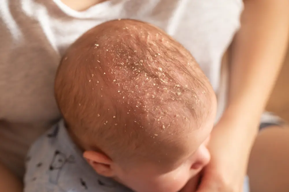 seborrea capilar en bebes remedios caseros - Cómo sacar la grasita de la cabeza de los bebés