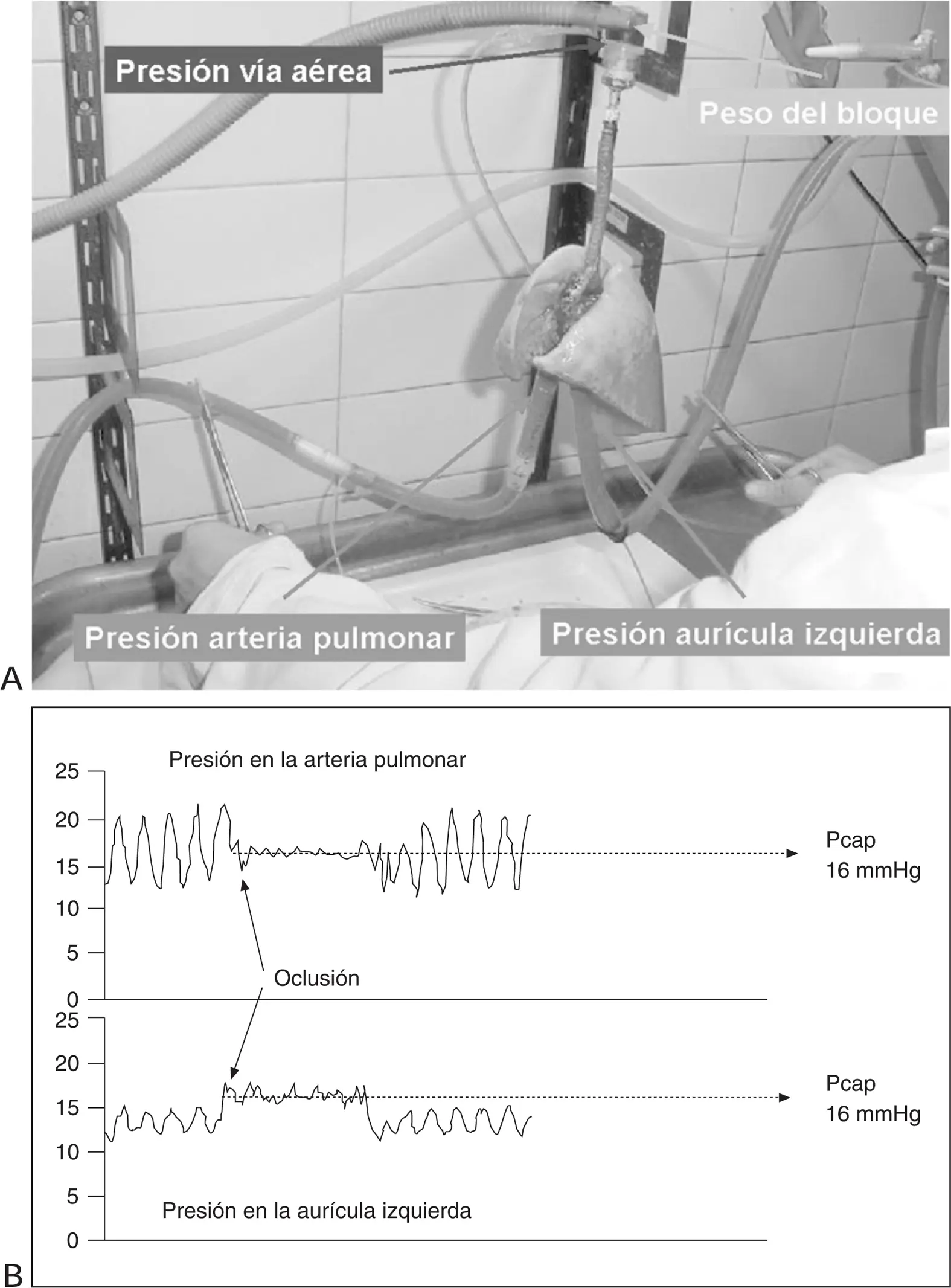 enclavamiento capilar pulmonar - Cómo se mide la presión capilar pulmonar