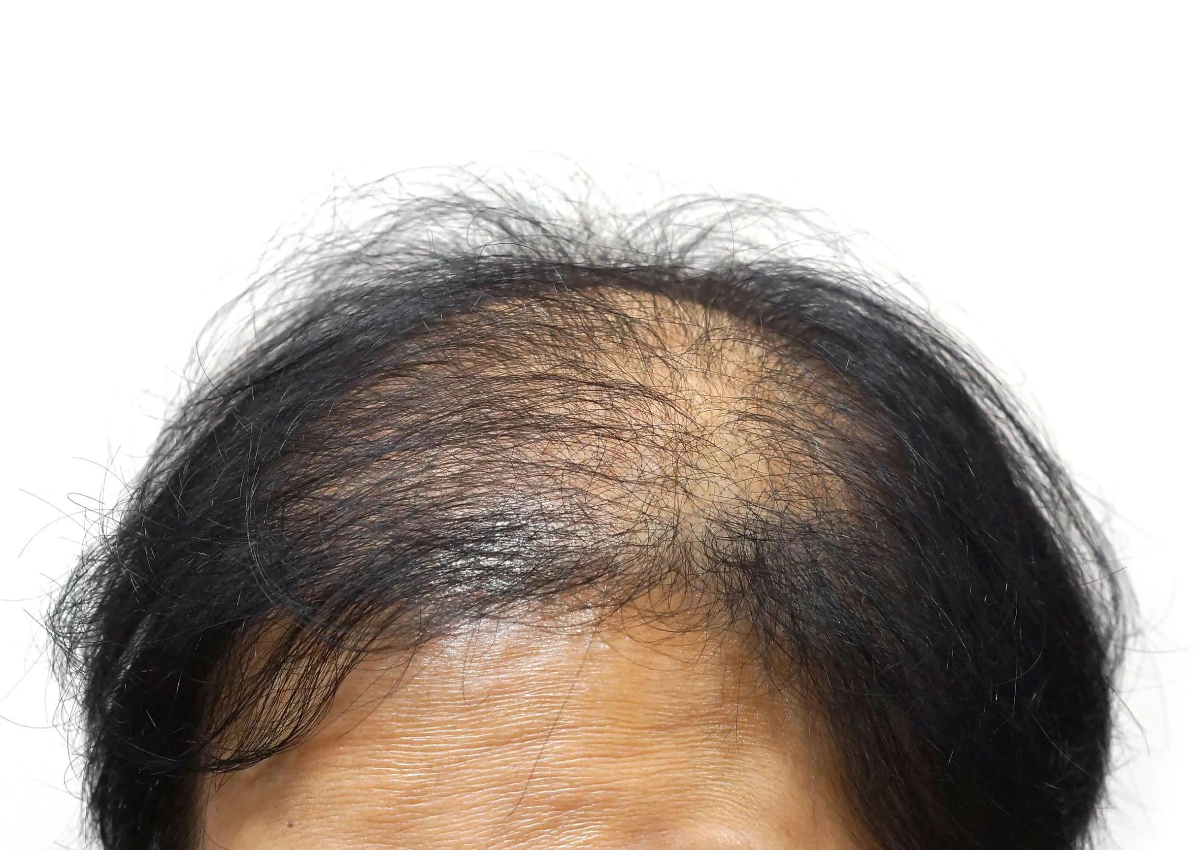 cambios en el pelo en la menopausia - Cómo se pone el cabello en la menopausia