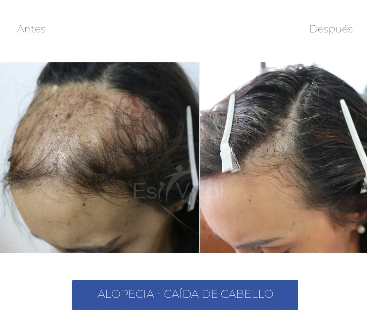 mesoterapia capilar en caseros - Cómo se realiza la mesoterapia para el cabello