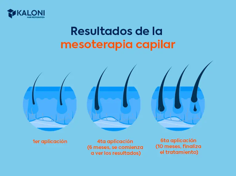 cuando hace efecto la mesoterapia capilar - Cuándo empieza a hacer efecto la mesoterapia