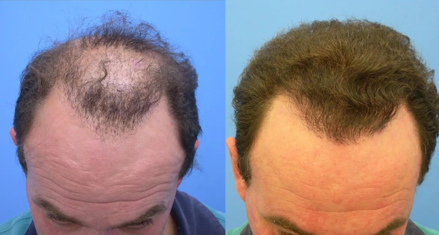 plasma rico en plaquetas cabello para suprimir trasplante capilar - Cuándo puedo hacerme un PRP después del trasplante capilar