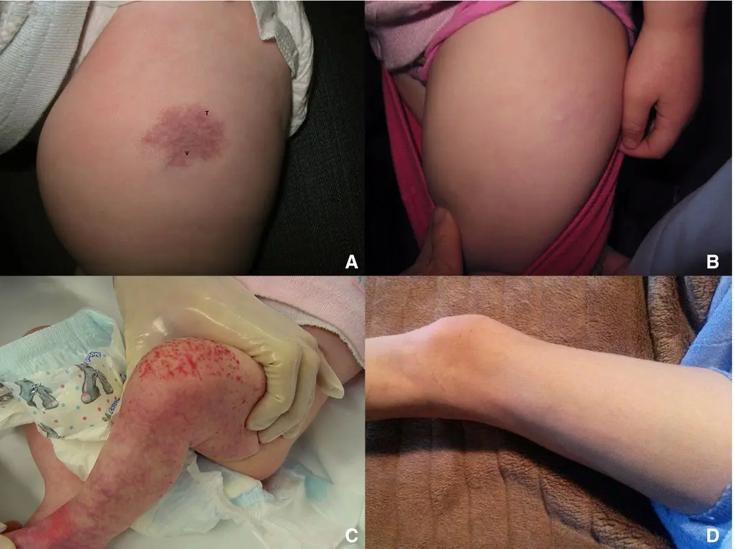 hemangioma capilar lobular tratamiento - Cuándo se debe operar un hemangioma