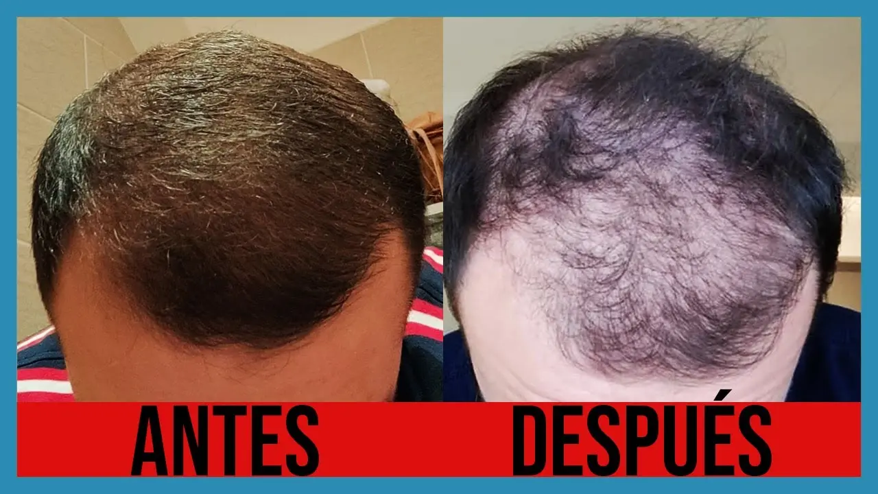 al dejar de usar minoxidil se cae el pelo - Cuándo se deja de caer el pelo con minoxidil