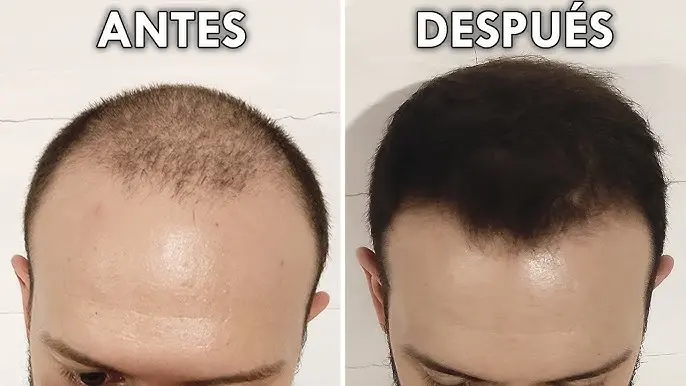 minoxidil pelo antes y despues - Cuándo se empieza a notar los resultados del minoxidil