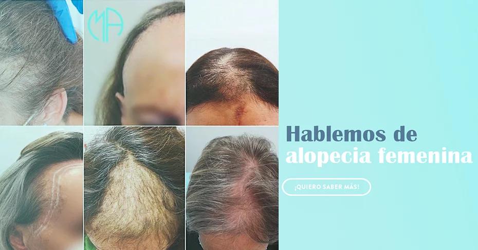 alopecia mujeres centro capilar caba argentina - Cuánto cuesta un tratamiento para alopecia