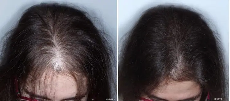 caida del cabello despues de cirugia capilar - Cuánto dura la caída del cabello después de la cirugía