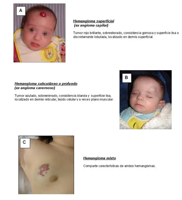 definicion hemangioma lobular capilar piel - Cuántos tipos de hemangiomas hay