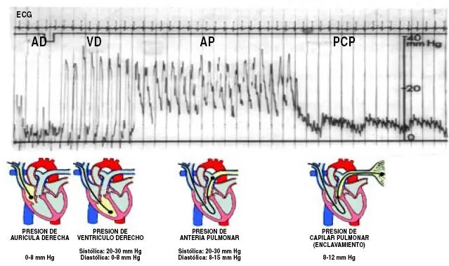 capilar enclavamiento wedge - Dónde se enclava el cateter de Swan Ganz