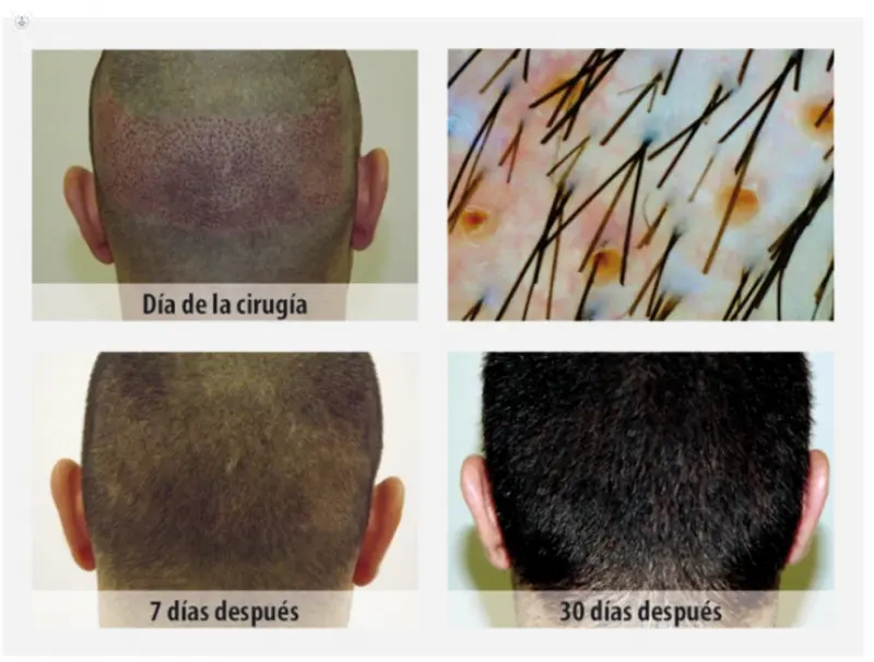 tecnica implante capilar fue - Es seguro el trasplante de cabello fue