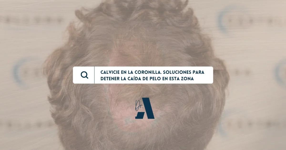 me falta pelo en la coronilla - Por qué se pierde pelo en la coronilla