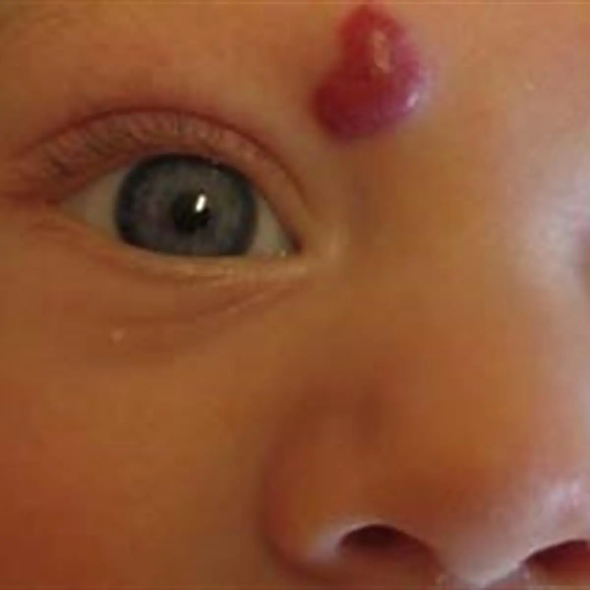 hemangioma capilar en niños - Por qué se producen los hemangiomas