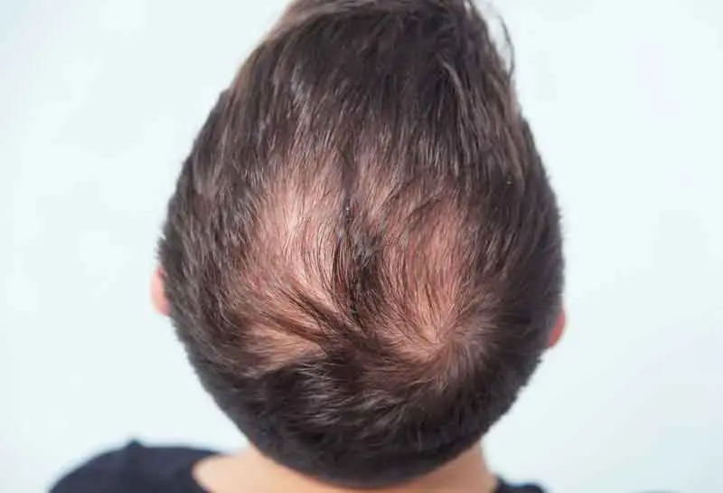 como aumentar el pelo en la coronilla - Puedes hacer que vuelva a crecer el cabello en la coronilla