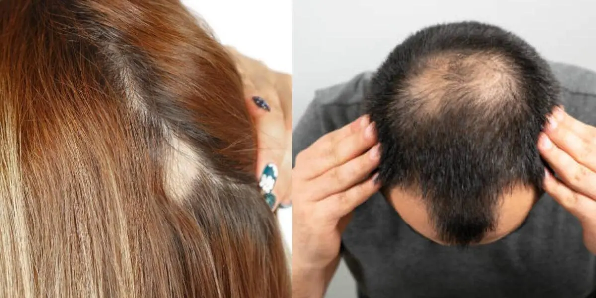 casi calva con muy poco pelo crucigrama - Que aún no tienen barba crucigrama