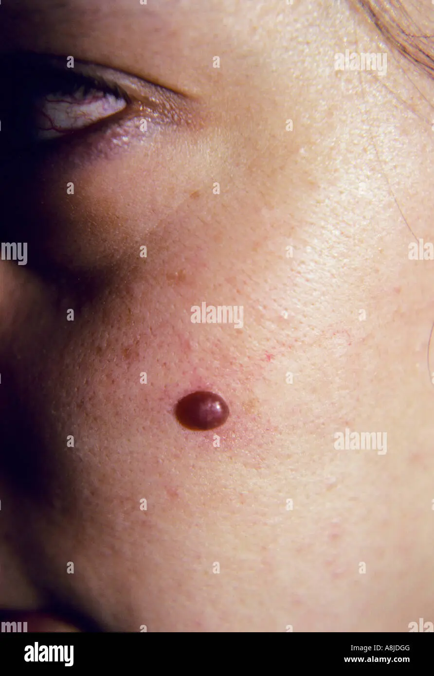 hemangioma capilar lobulillar imagen - Qué causa el hemangioma capilar lobular