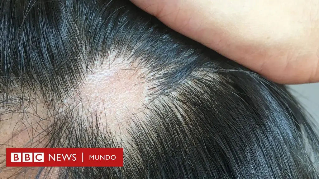 se me cae el pelo pero me crece - Qué deficiencia tengo si se me cae el cabello