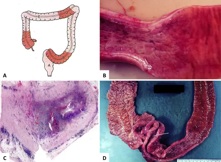 inflamacion de capilar intestinal - Qué enfermedad produce inflamación intestinal