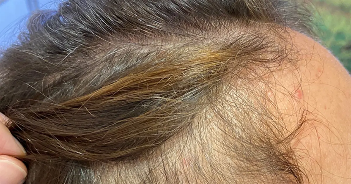 enfermedad femenina de crecimiento capilar - Qué enfermedades afectan el crecimiento del cabello