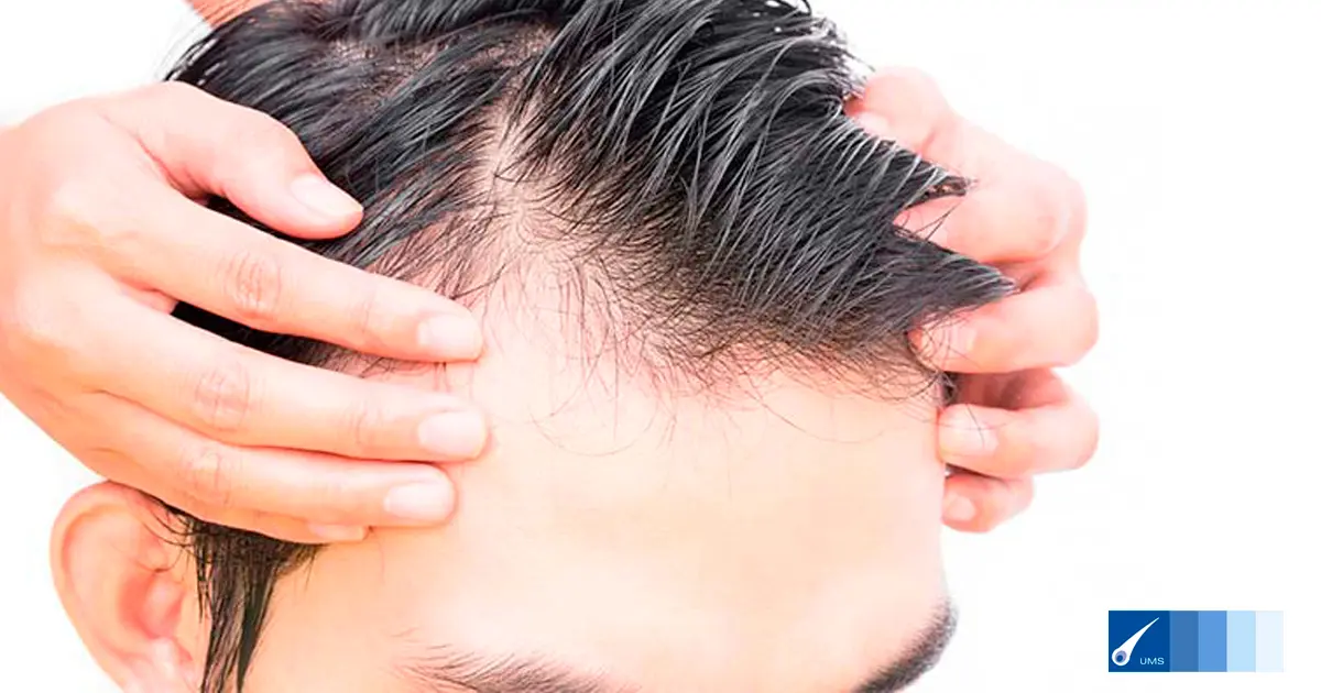 nacimiento de pelo nuevo - Qué es el nacimiento de cabello