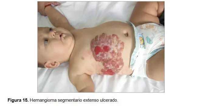 definicion hemangioma lobular capilar piel - Qué es un angioma plano