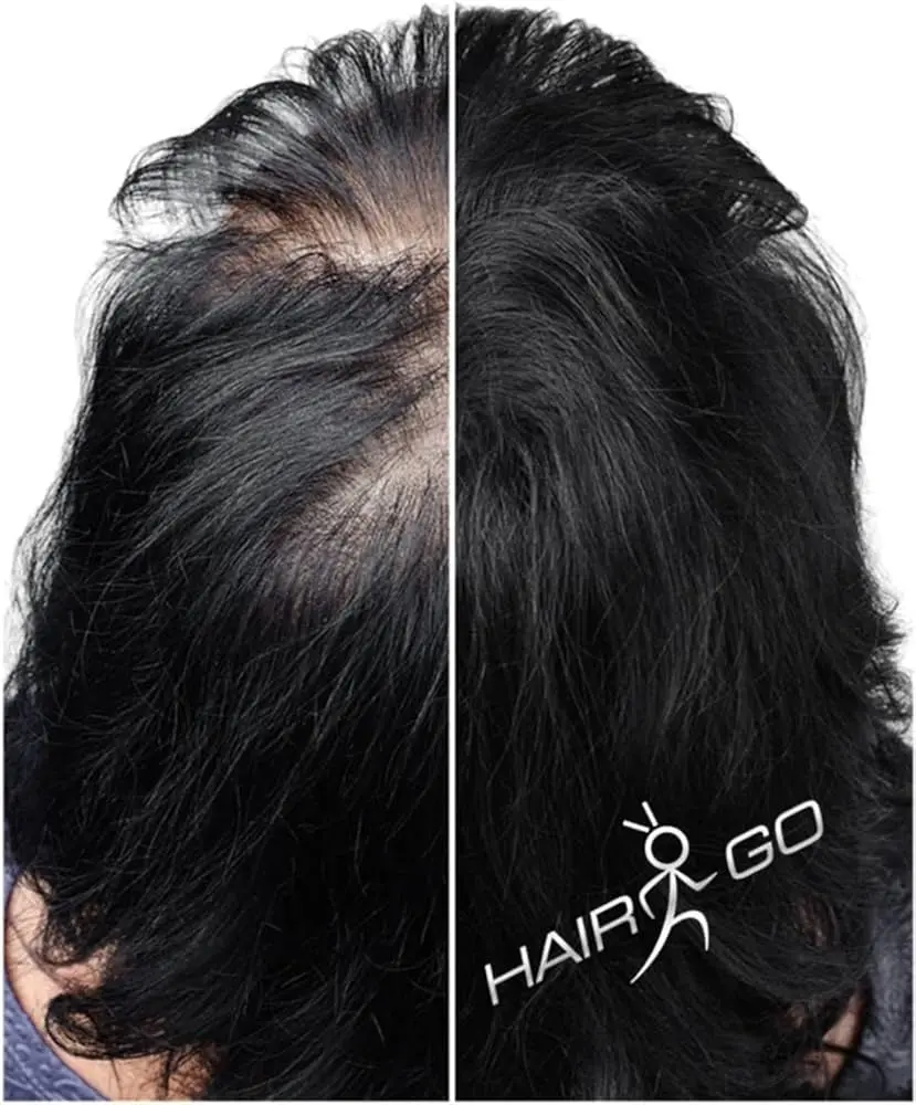 relleno capilar cabello - Qué es un relleno capilar en el cabello