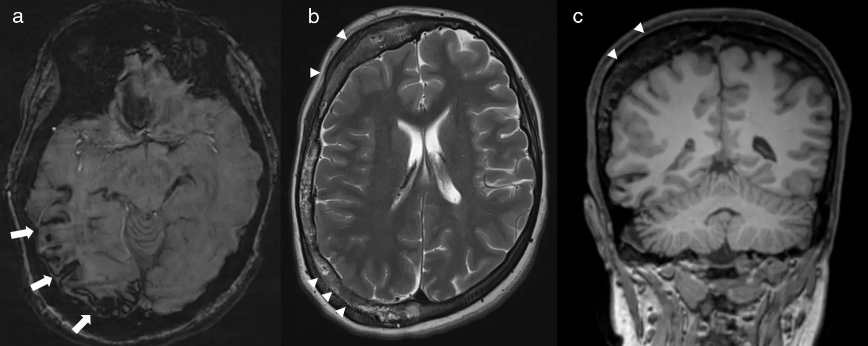 malformacion post capilar facial rm - Qué es una malformación arteriovenosa