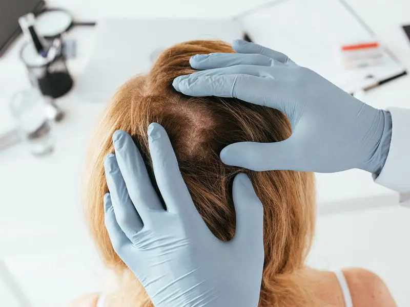 inyecciones en la cabeza para pelo - Que me puedo inyectar para la caída del cabello