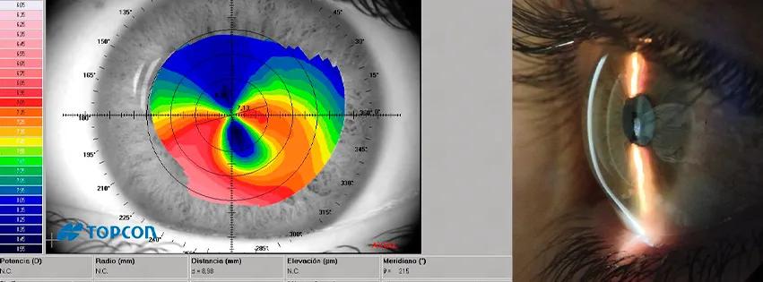 signo de bell en degeneracion marginal pelucida - Qué pasa cuando la córnea se adelgaza