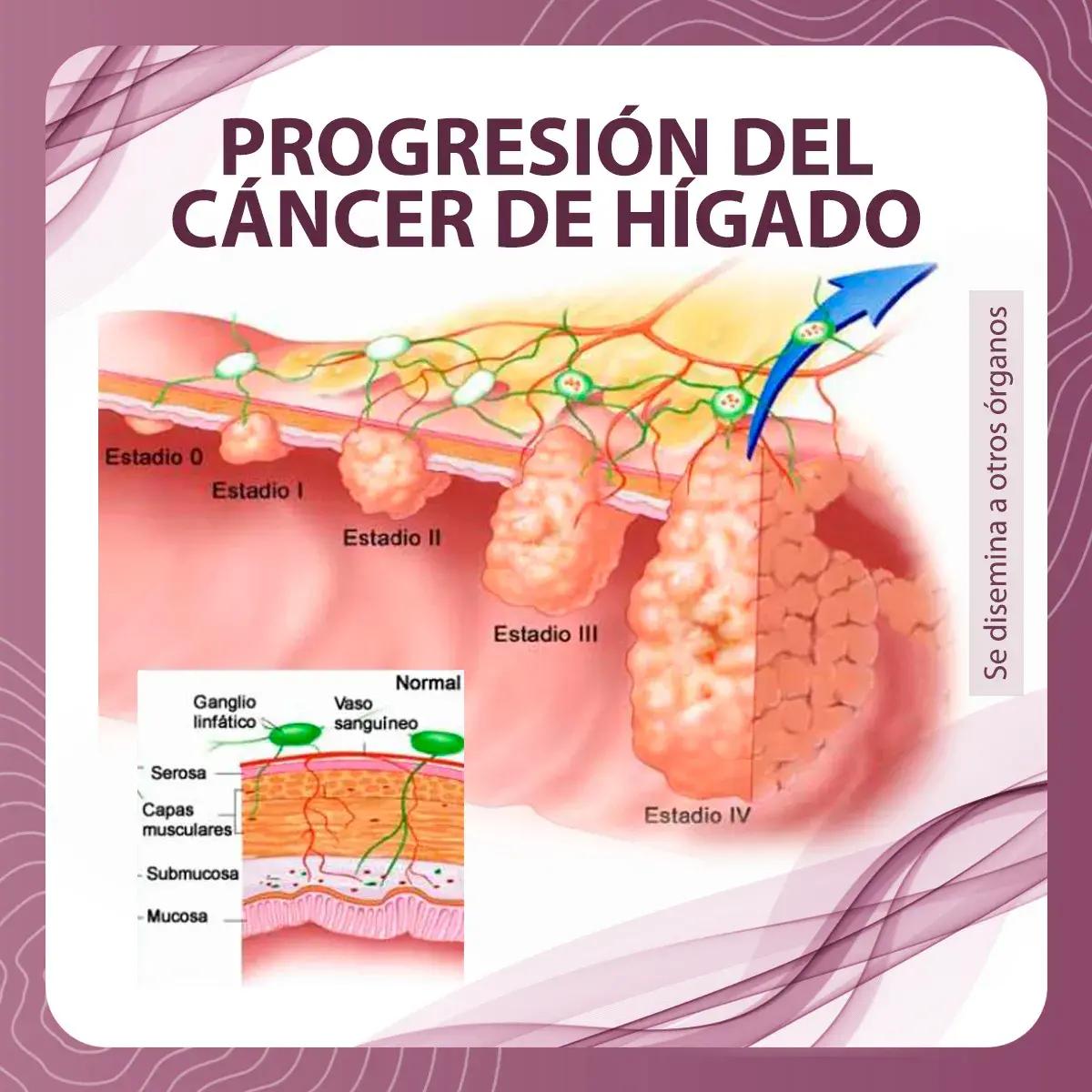 decoloracion capilar cancer higado - Qué pasa cuando una persona tiene cáncer en el hígado