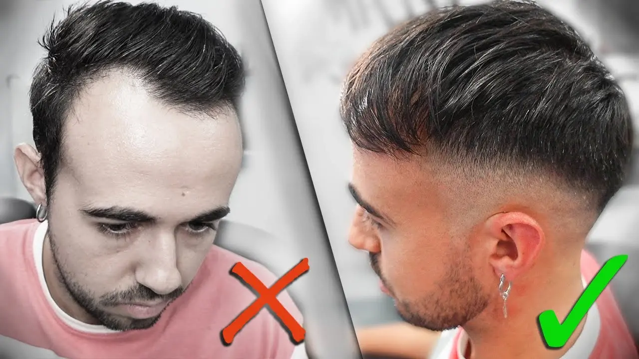 corte de pelo para alguien con entradas - Qué peinado debe tener un hombre con entrada de cabello