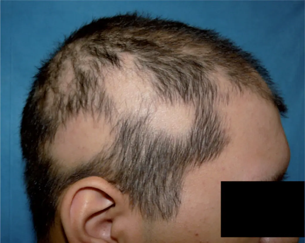 caida de pelo en niños por estres - Qué puede causar alopecia en niños