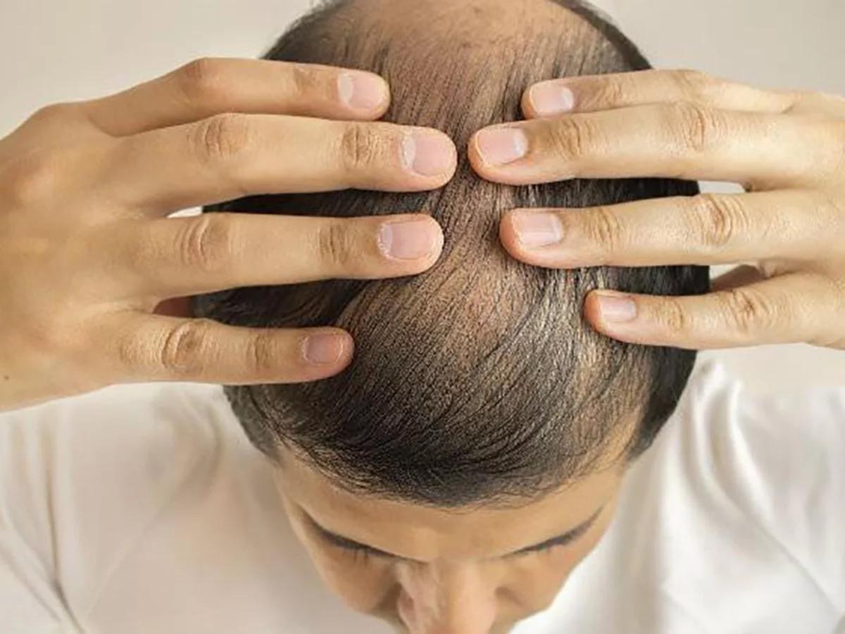 alguien probedicam para caida de pelo - Qué recetan los dermatólogos para la caída del pelo