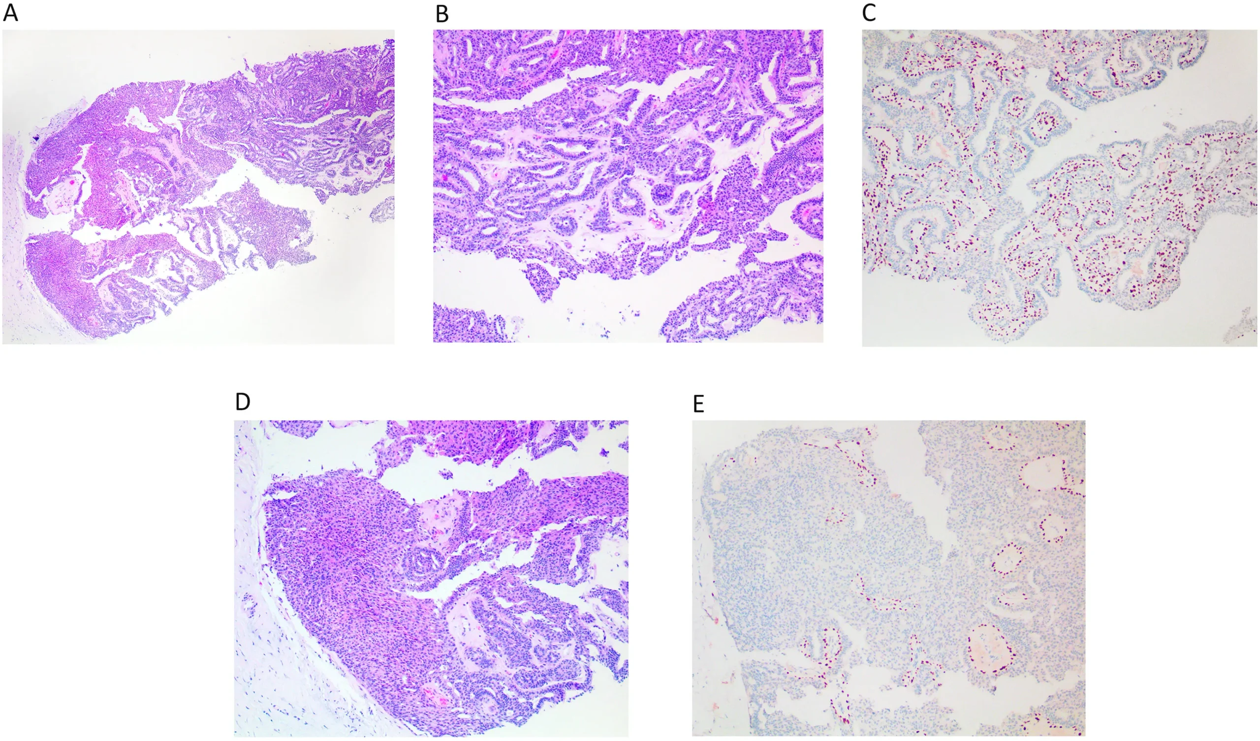 lesion capilar de localizacion parietoocipital - Qué son las formaciones papilares