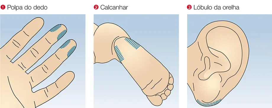 a que paciwmtes realizobla realizo una puncion capilar - Qué tipo de pacientes es aconsejable para una colección capilar