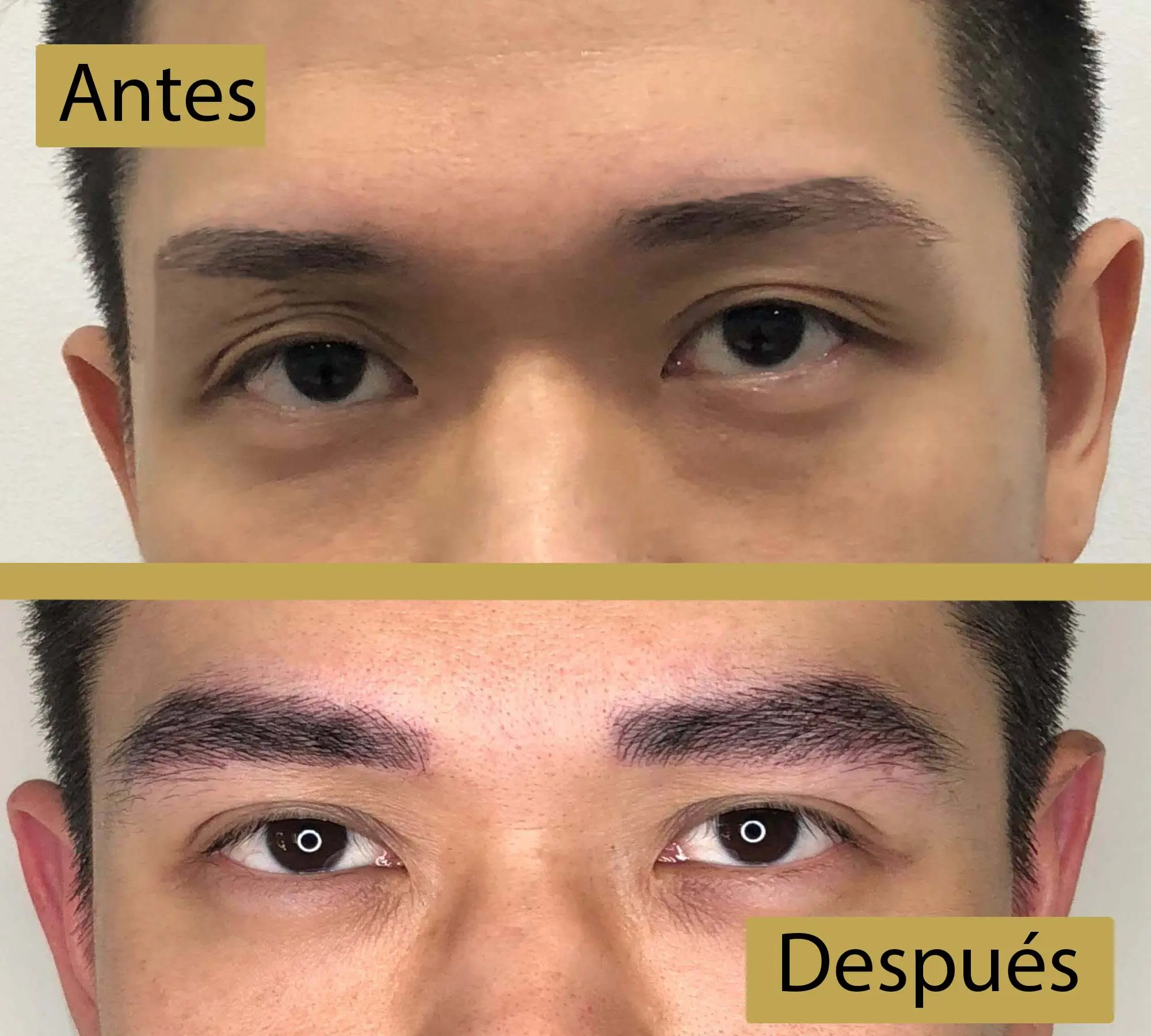 implante capilar cejas - Se pueden hacer implantes capilares en las cejas